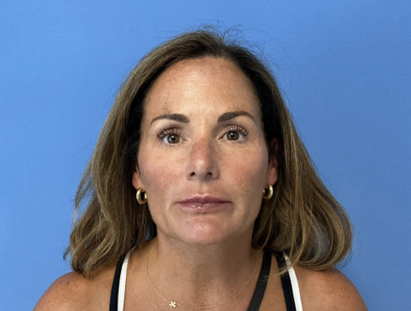 Rhinoplasty--Case-Study-2853 | After Rhinoplasty